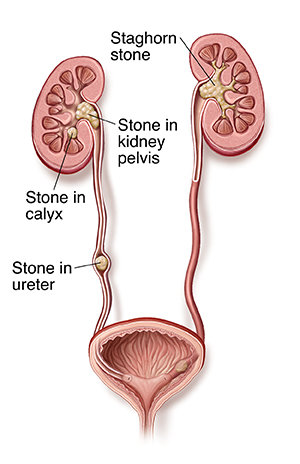 Urinary tract showing stone in ureter and stones in kidneys.
