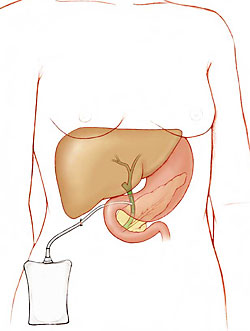 Outline of body showing T-tube in bile duct connected to bag on outside of abdomen.