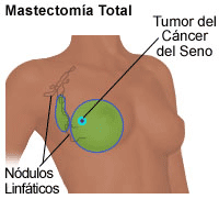 Ilustración de una mastectomía total