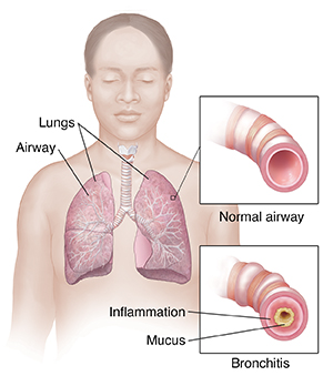 Vista frontal del cuerpo de una mujer en donde se observa el sistema respiratorio. Recuadros en los que se ven una vía respiratoria normal y una vía respiratoria con bronquitis.