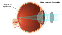 Ilustración sobre la miopía