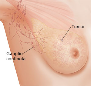 Vista de tres cuartos de la zona de una axila femenina donde puede verse un tumor y el ganglio linfático centinela.