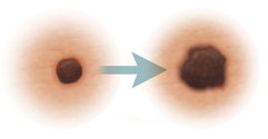 Lesiones en la piel en las que se muestra la evolución del cáncer de piel.