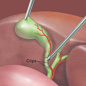 Instrumento quirúrgico que toma la vesícula biliar. Otro instrumento listo para cortar el conducto cístico y la arteria. El conducto cístico y la arteria tienen pinzas para sellarlos.