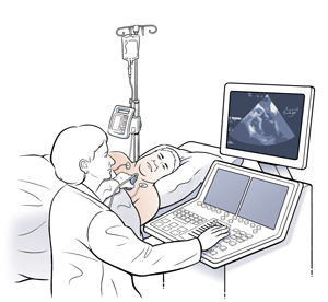 Hombre acostado de lado sobre una mesa de examen con cables de electrocardiograma en el pecho. Un técnico sostiene una sonda de ecografía sobre el pecho del hombre. 