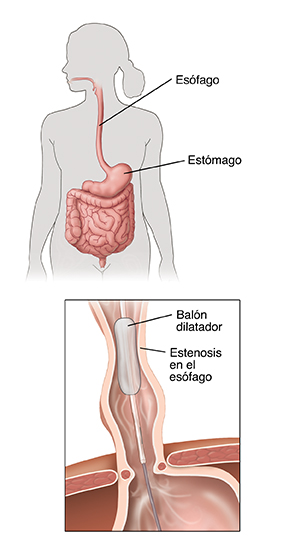Contorno de una figura humana que muestra el sistema digestivo. En el recuadro, se observa el balón que ensancha la estenosis en el esófago.