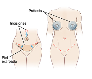 Dos imágenes de un abdomen femenino: en la primera imagen se observan las incisiones y el tejido extirpado para la abdominoplastia. en la segunda imagen se observa el resultado final de la abdominoplastia más los implantes mamarios.