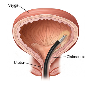 Corte transversal visto de frente de una vejiga en donde se ve un citoscopio insertado a través de la uretra y hasta la vejiga.