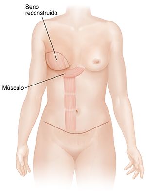 Vista frontal de senos femeninos y abdomen donde puede verse una reconstrucción de seno con colgajo TRAM.