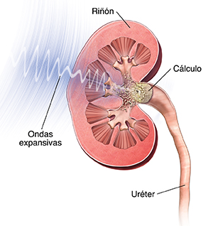 Sección transversal del riñón que muestra cómo las ondas de choque rompen los cálculos renales.