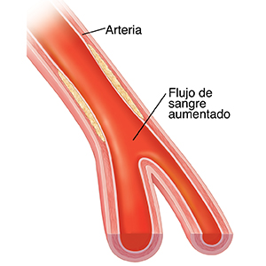 Corte transversal de una arteria con placa comprimida después de una angioplastia con balón.