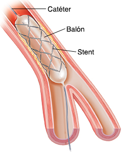 Corte transversal de una arteria donde puede verse un catéter con balón colocando un stent.