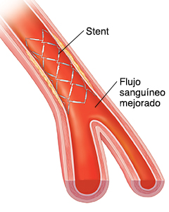 Corte transversal de una arteria en el que se ve la sangre que pasa a través del stent.