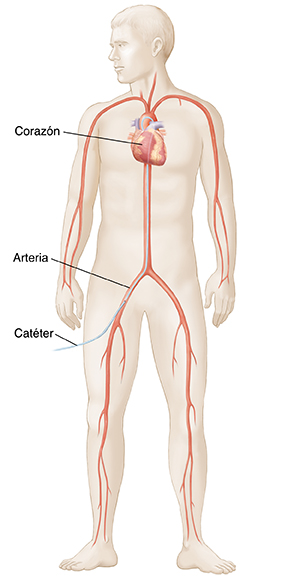 Cuerpo de hombre con un catéter insertado en la pierna que va hasta una arteria del corazón. 