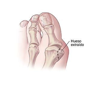 Vista superior de un dedo gordo del pie con una línea de puntos que muestra el hueso que se debe extirpar para osteotomía en tejadillo para juanete.