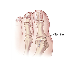 Vista superior de un dedo gordo del pie con un tornillo que sostiene los huesos juntos después de una osteotomía en tejadillo para juanete.