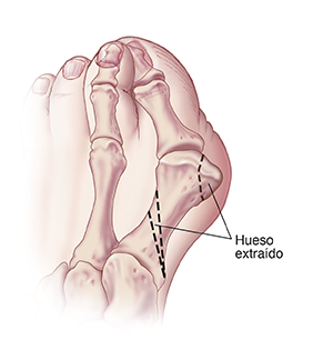 Vista superior de un dedo gordo del pie con una línea de puntos que muestra las áreas del hueso que se deben extirpar para osteotomía base para juanete.
