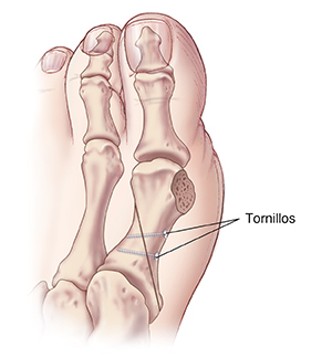 Vista superior de un dedo gordo del pie con tornillos que sostienen los huesos juntos después de una osteotomía base para juanete.