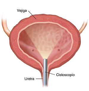 Corte transversal de vista frontal de la vejiga en donde se ve un citoscopio insertado a través del uretra.