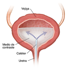Corte transversal de la vejiga donde se observa un catéter insertado a través del uréter que libera medio de contraste para radiografías.
