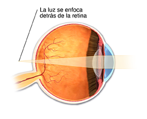 Corte transversal de un ojo con hipermetropía, con la luz enfocando detrás de la retina.