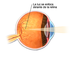 Corte transversal de un ojo con miopía, con la luz enfocando por delante de la retina.