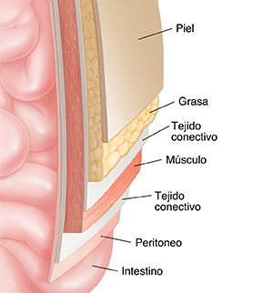 Corte transversal de una pared abdominal sobre el intestino que muestra distintas capas: piel, grasa, fascia, músculo y peritoneo.