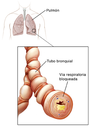 Contorno de un torso humano, donde se ven la tráquea y los pulmones. Primer plano de tubos bronquiales que muestran inflamación y acumulación de mucosidad.