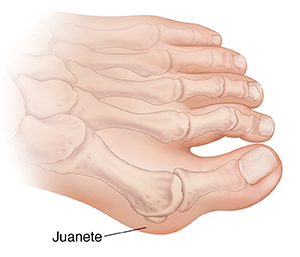 Vista superior del pie, donde pueden verse los huesos en imagen fantasma. Se muestra un juanete.