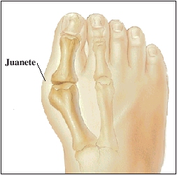 Parte superior del pie que muestra los huesos del dedo gordo y un juanete moderado.