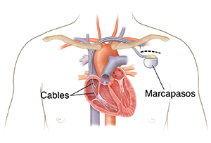 Contorno del pecho de un hombre en el que puede verse un marcapasos colocado con cables que van hacia las cámaras del corazón.