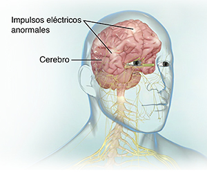 Vista lateral de una cabeza donde se observa el cerebro con impulsos eléctricos anormales.