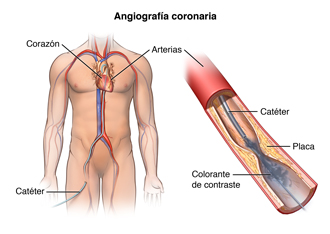 El cuerpo de un hombre con un catéter insertado en la pierna y llega hasta una arteria del corazón. Se inyecta un colorante. 