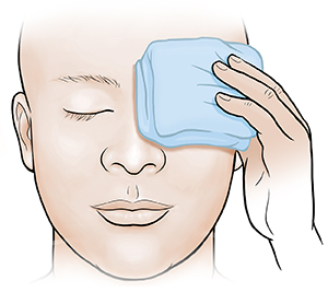 Adult holding cold compress on eye.