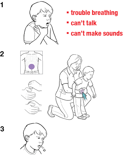 3 steps in giving abdominal thrusts to child as first aid for choking.