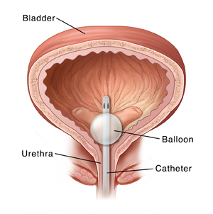 Cross section of bladder showing catheter in place.