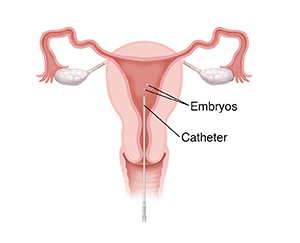 Front view cross section of uterus showing catheter inserting embryos into uterus during in vitro fertilization.