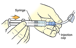 Closeup of gloved hands using needleless syringe to inject solution into catheter injection cap.