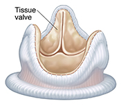 Tissue heart valve.