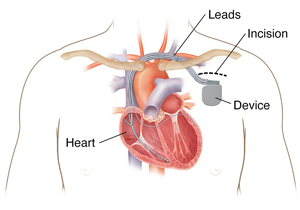Outline of chest showing biventricular implantable cardioverter defibrillator in chest with 3 leads going into heart chambers.