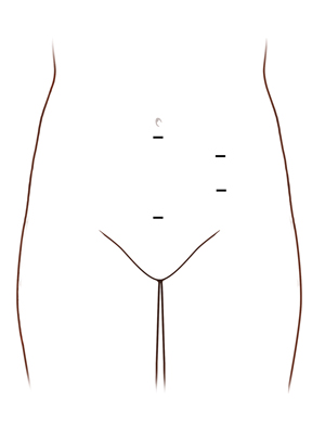 Front view of female abdomen showing possible incision sites for pelvic laparoscopic surgery.