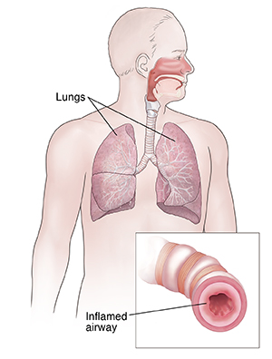 Front view of person showing respiratory system. Inset shows inflamed airway.