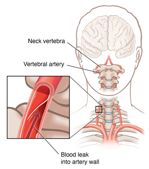 Front view of head showing the vertebral arteries and a detailed view of a vertebral artery dissection.