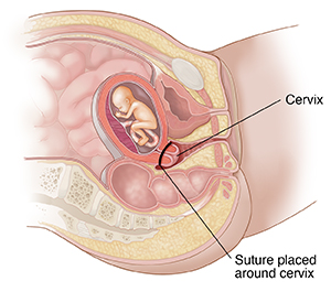 Cross section of female pelvis and abdomen showing fetus in uterus and stitch holding cervix closed.