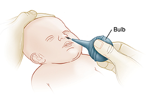 Adult inserting bulb syringe into baby's nose, while holding baby's head steady.