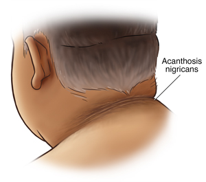 Back of neck showing acanthosis nigricans.