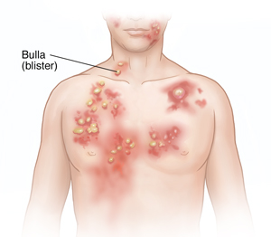 Front view of male head and chest showing bullous pemphigoid.