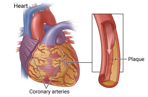 Heart showing two coronary arteries, with detail of artery narrowed by plaque.