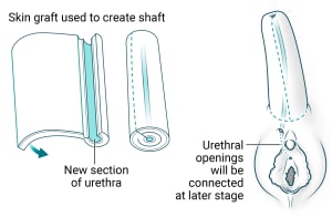 A skin graft is used to create shaft of penis with new section of urethra. Shaft is attached above the existing clitoris. Urethral openings will be connected at a later stage.