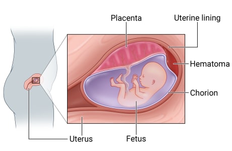 Location of uterus during pregnancy and close-up showing fetus, chorion, uterine lining, and placenta, with blood between uterine lining and chorion.